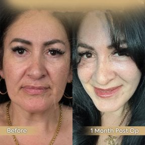 Facial fat transfer before and after results at Dr. Safa Manav Clinic, 1 month post-op