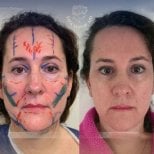 Before and after facial fat transfer results at Dr. Safa Manav Clinic, improved facial volume