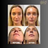 Vorher-nachher-Ergebnisse der Revision-Rhinoplastik in der ID Clinic Bangkok, verbesserte Nasenform