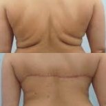 Vorher-nachher-Ergebnis Backlift bei ID Clinic Bangkok, verbesserte Rückenform