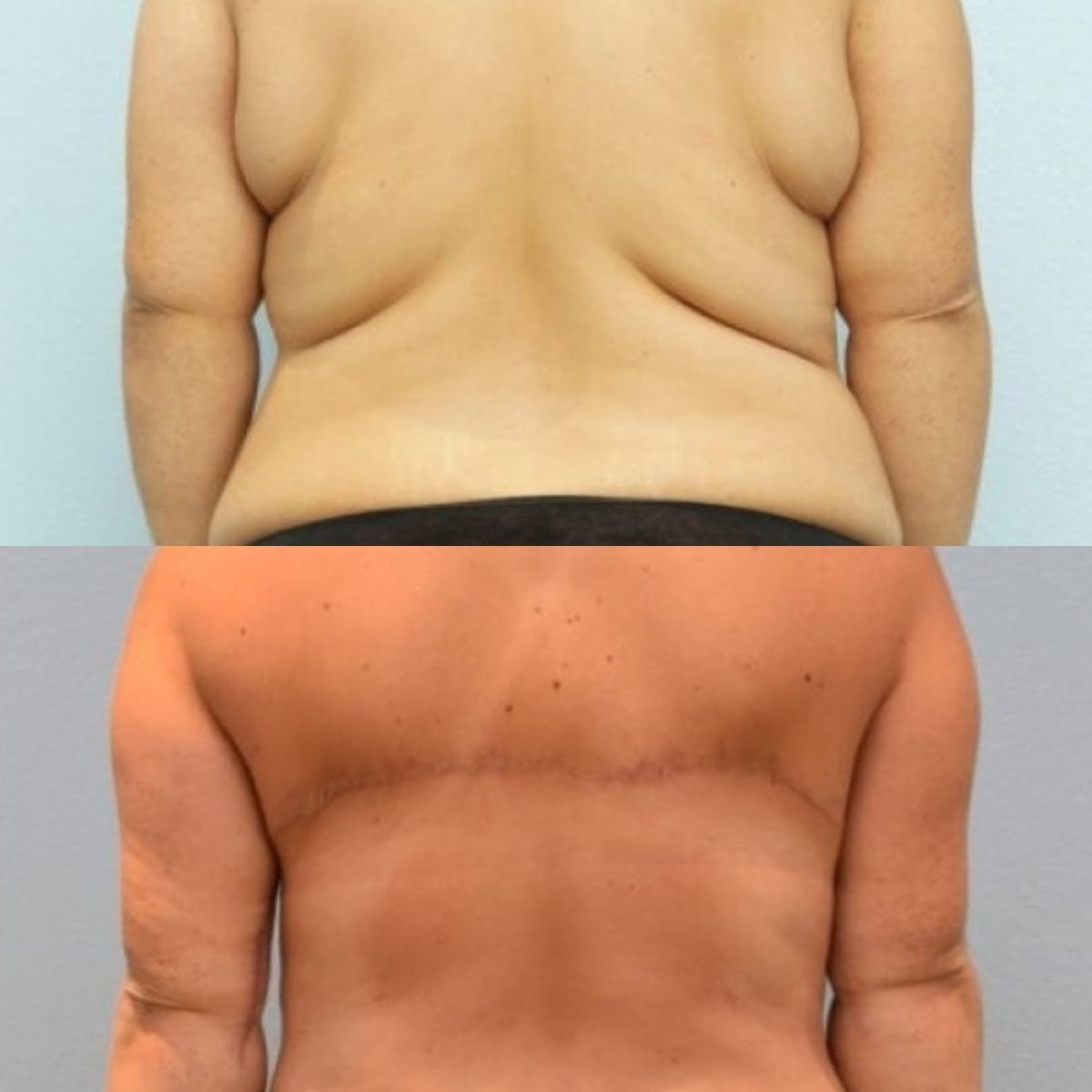 Resultados de lifting de espalda antes y después en ID Clinic Bangkok, contorno mejorado