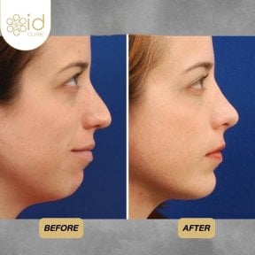 Vorher-nachher-Ergebnis der Nasenkorrektur bei ID Clinic Bangkok, natürliche Nasenform