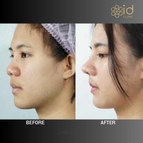 Vorher-nachher-Ergebnis der Nasenkorrektur bei ID Clinic Bangkok, natürliche Nasenform