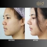 Vorher-nachher-Ergebnis der Nasenkorrektur bei ID Clinic Bangkok, natürliche Nasenform