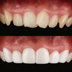 نتائج قبل وبعد عدسات الأسنان في 365SeoulOneTop365 Dental Clinic، تحول الابتسامة