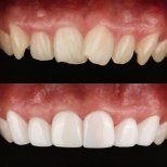 نتائج قبل وبعد عدسات الأسنان في 365SeoulOneTop365 Dental Clinic، تحول الابتسامة