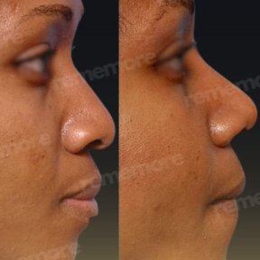 Before and after rhinoplasty results at Memorial Şişli Hospital, improved nose profile