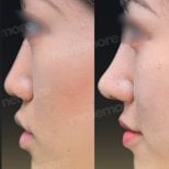 Результаты ринопластики до и после в Memorial Şişli Hospital, улучшенный профиль носа