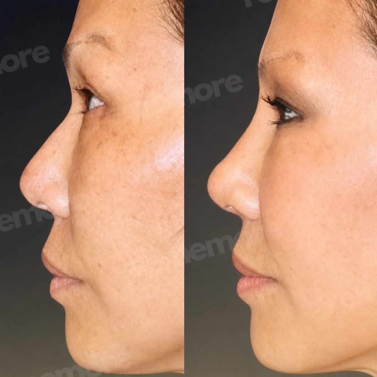 نتائج تجميل الأنف قبل وبعد في مستشفى ميموريال شيشلي، تحسين شكل الأنف
