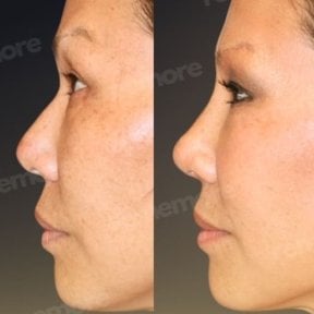 Результаты ринопластики до и после в Memorial Şişli Hospital, улучшенный профиль носа