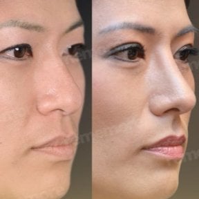 Результаты ринопластики до и после в Memorial Şişli Hospital, улучшенная форма носа