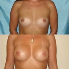Before and after breast augmentation results at Memorial Şişli Hospital, enhanced breast volume