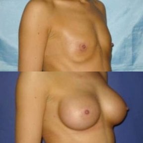 Before and after breast augmentation results at Memorial Şişli Hospital, enhanced breast shape