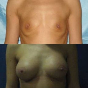 Before and after breast augmentation results at Memorial Şişli Hospital, enhanced breast shape