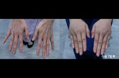 Resultados de rejuvenecimiento de manos con lipofilling en HERSHE Plastic Surgery Korea antes y después