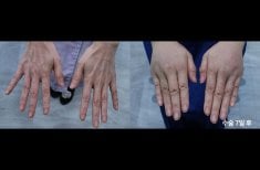 Resultados de rejuvenecimiento de manos con lipofilling en HERSHE Plastic Surgery Korea antes y después