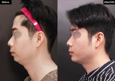 До и после контурирования лица в VG Plastic Surgery – улучшенная линия подбородка