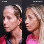 Vorher-nachher-Ergebnis Oberlidstraffung bei VG Plastic Surgery, sichtbare Augenverjüngung