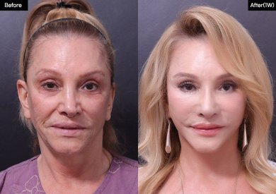 Vorher-nachher-Ergebnis Oberlidstraffung bei VG Plastic Surgery, verjüngtes Augenbild