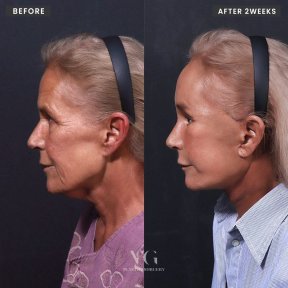 Vorher-nachher-Ergebnis Facelift bei VG Plastic Surgery, sichtbare Verjüngung nach 2 Wochen