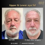 Before and after lower eyelid blepharoplasty results at ID Clinic Bangkok, reduced eye bags