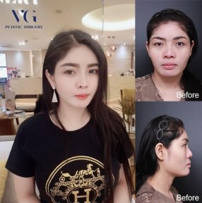 Vorher-nachher-Rhinoplastik bei VG Plastic Surgery, verbesserte Nase und Gesichtsharmonie