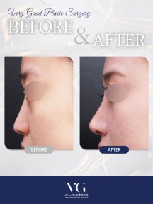 Vorher-nachher-Ergebnis der Nasenkorrektur bei VG Plastic Surgery, verbesserte Nasenkontur