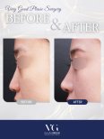 Vorher-nachher-Ergebnis der Nasenkorrektur bei VG Plastic Surgery, verbesserte Nasenkontur