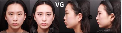 Vorher-nachher-Ergebnisse der Nasenkorrektur bei VG Plastic Surgery, verbesserte Nasenform