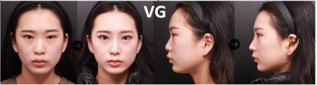 Vorher-nachher-Ergebnisse der Nasenkorrektur bei VG Plastic Surgery, verbesserte Nasenform