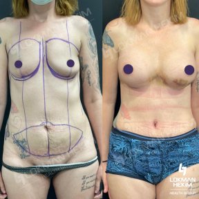 before-after photo breast-augmentation