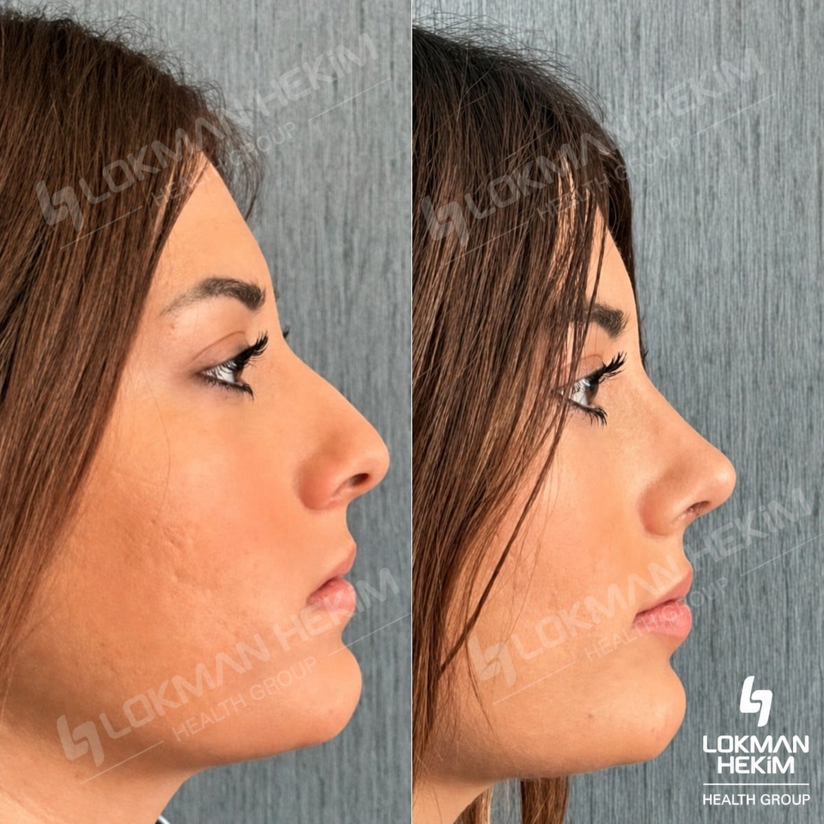 نتائج عملية تجميل الأنف قبل وبعد في مستشفى لوكمان حكيم إسطنبول، إعادة تشكيل الأنف