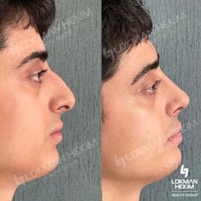 Before and after rhinoplasty results at Lokman Hekim Istanbul Hospital, improved nose profile