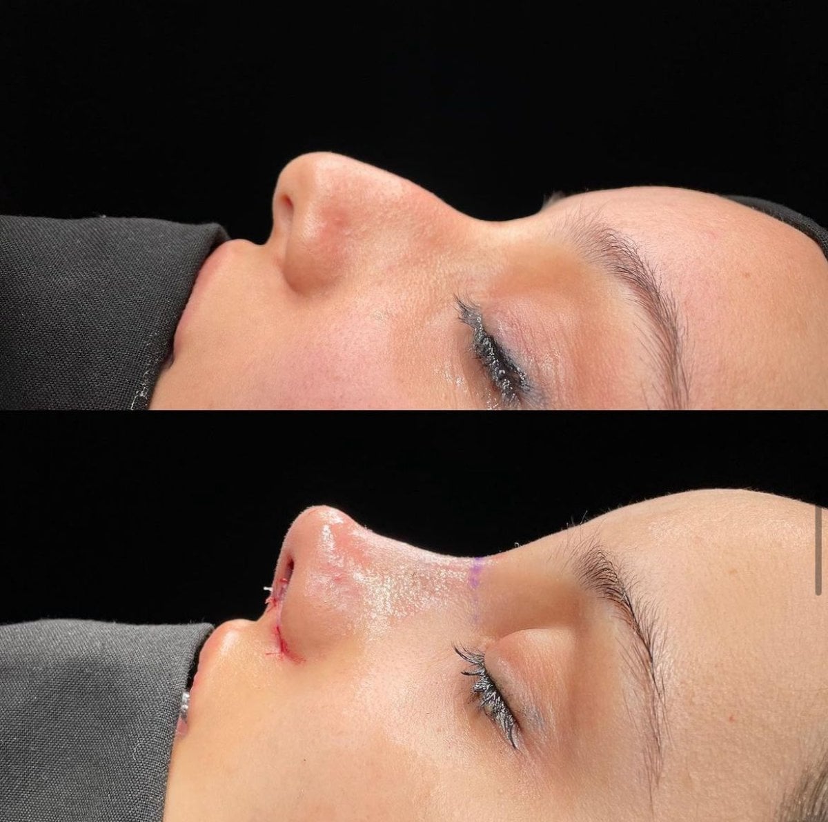 Resultados de rinoplastia antes y después en Memorial Bahçelievler Hospital, remodelación nasal