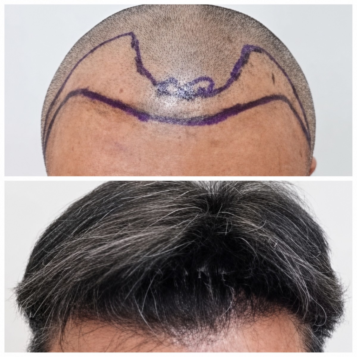 نتائج زراعة الشعر FUE قبل وبعد في قسم الجلد والجراحة - مستشفى نافامين9