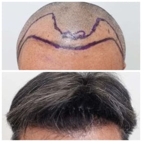 Vorher-nachher-Ergebnisse FUE-Haartransplantation in Department of Skin & Surgery - NAVAMIN9 HOSPITAL