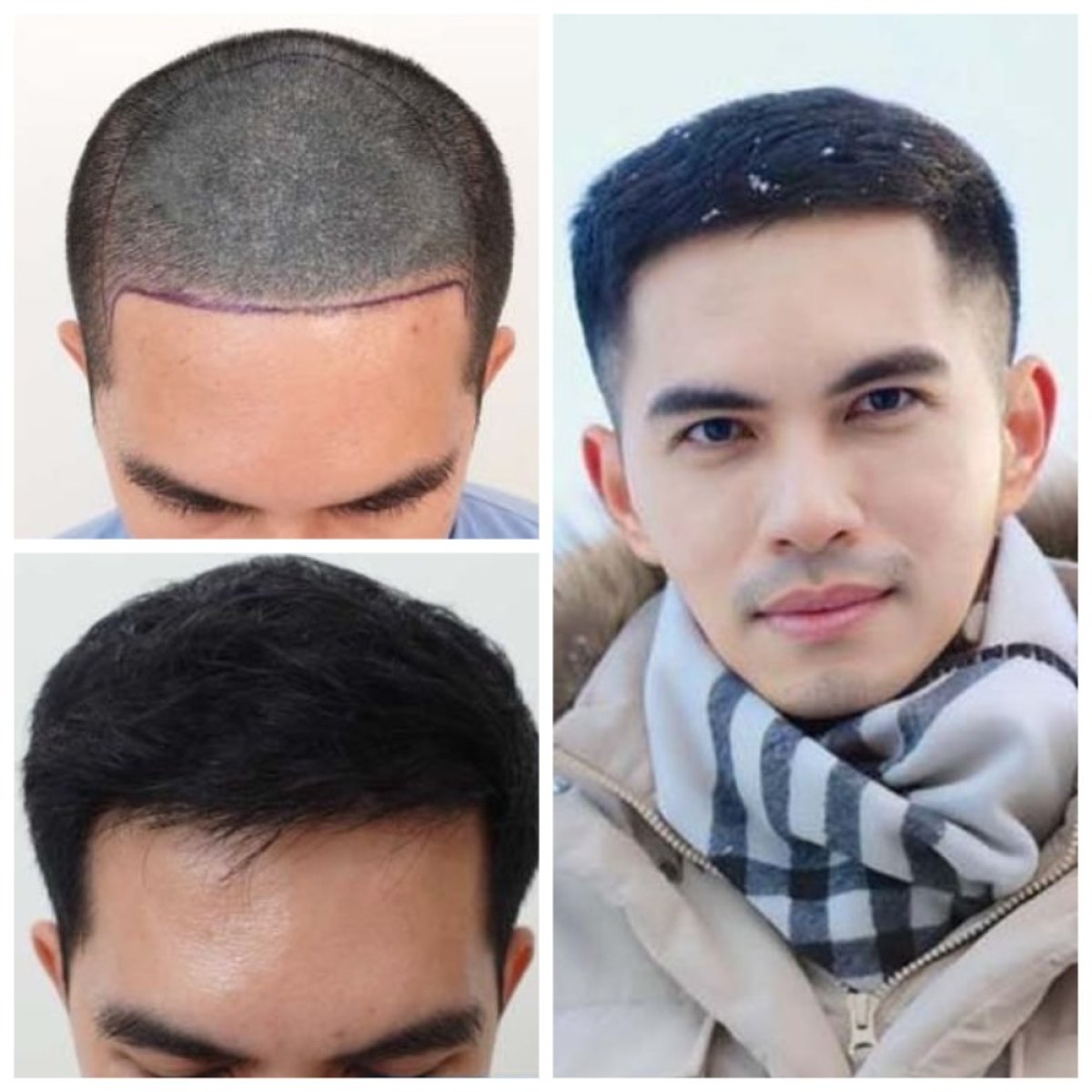 نتائج زراعة الشعر FUE قبل وبعد في قسم الجلد والجراحة - مستشفى نافامين9