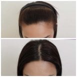 Before and after hair transplant results at Department of Skin & Surgery - NAVAMIN9 HOSPITAL