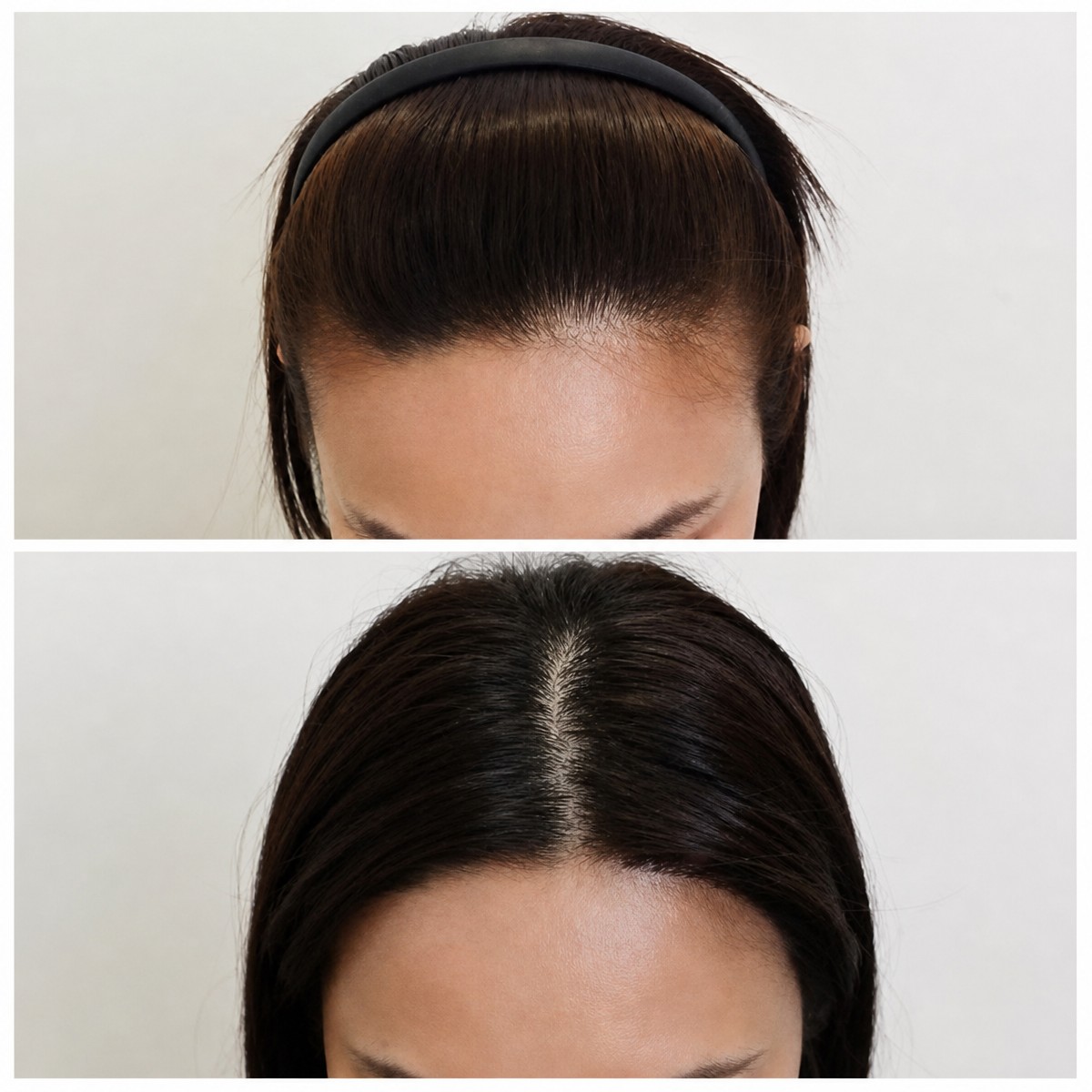 Resultado antes y después de No Shave Hair Transplant en Department of Skin & Surgery - NAVAMIN9 HOSPITAL