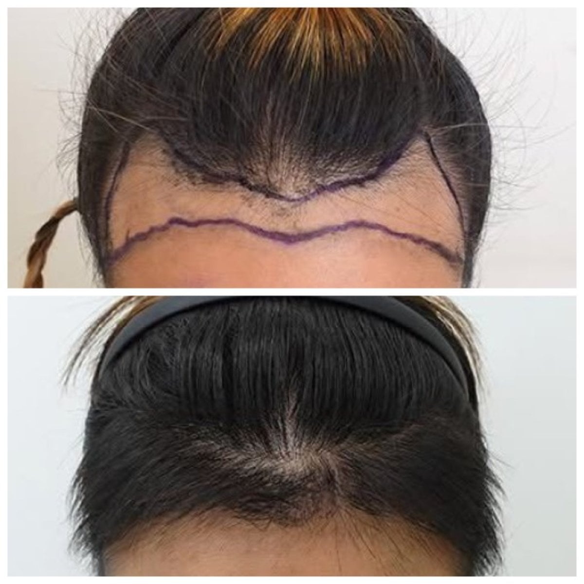 نتائج زراعة الشعر قبل وبعد في قسم الجلد والجراحة - مستشفى نافامين9