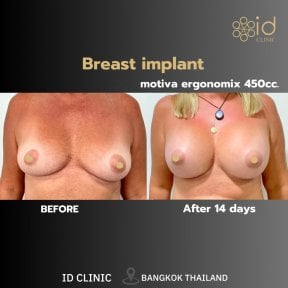before-after photo breast-implants-with-breast-lift