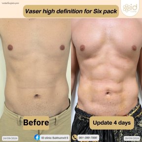 Before and after Vaser high definition liposuction for six pack at ID Clinic Bangkok results