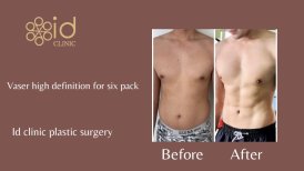 Before and after Vaser liposuction for six pack abs at ID Clinic Bangkok, visible muscle definition