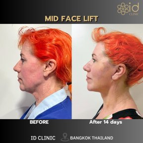 Vorher-nachher-Ergebnis Mid-Facelift bei ID Clinic Bangkok, sichtbare Verjüngung