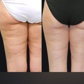 Before and after liposuction results at Memorial Şişli Hospital, smoother thighs and buttocks