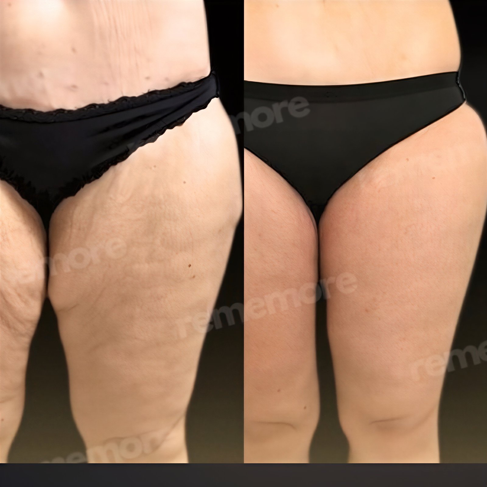Resultados de liposucción antes y después en Memorial Şişli Hospital, mejora de muslos