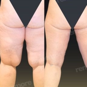 Before and after liposuction results at Memorial Şişli Hospital, thigh contour improvement
