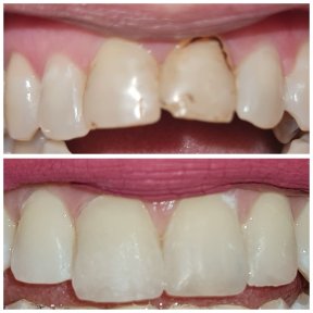 Vorher-nachher-Ergebnis Zahn-Bonding bei abgebrochenen Frontzähnen in SoftDentalCare Clinic
