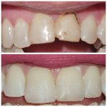 Vorher-nachher-Ergebnis Zahn-Bonding bei abgebrochenen Frontzähnen in SoftDentalCare Clinic