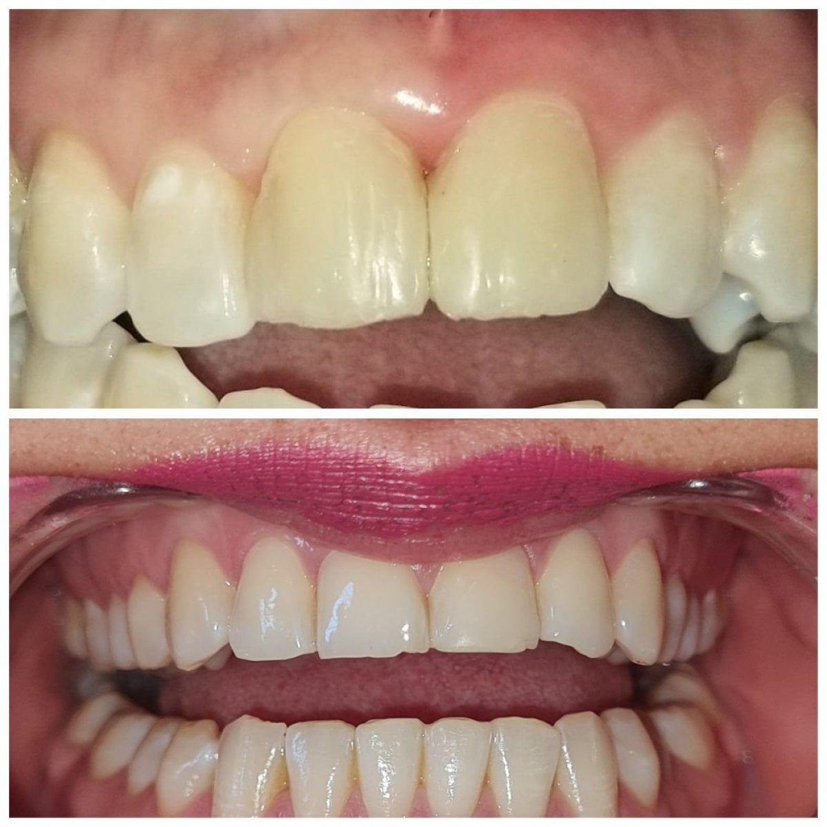 نتائج قبل وبعد ترابط الأسنان في SoftDentalCare Clinic – تحسين لون وشكل الأسنان